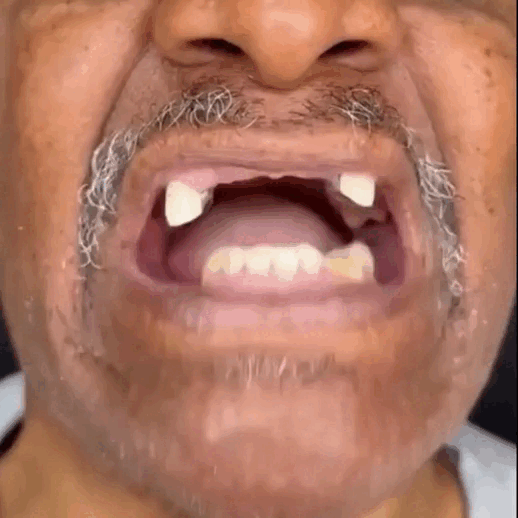 Moldable False Teeth™ – Solution pour Dents Cassées ou Manquantes