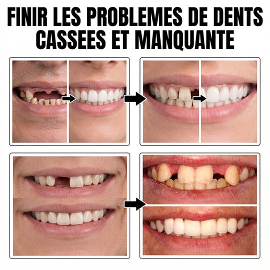 Moldable False Teeth™ – Solution pour Dents Cassées ou Manquantes