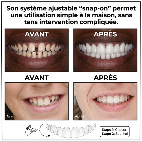 BLSEX-Prothèse Anti-Dents Cassées